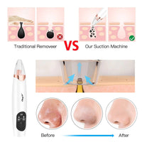 Blackhead Remover Vacuum Exfoliator Face Suction Device Allmartdeal