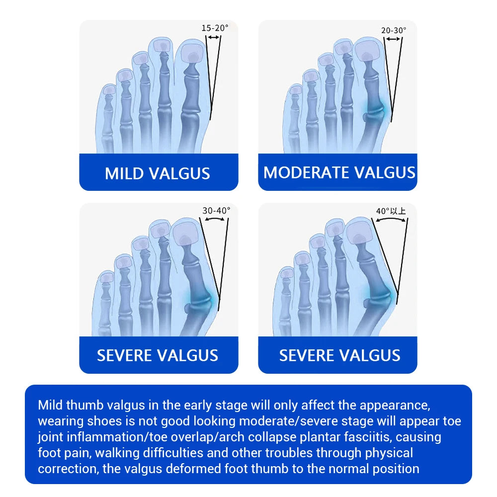 Toe Adjuster Orthotics Bone Thumb Adjustable Tool Care